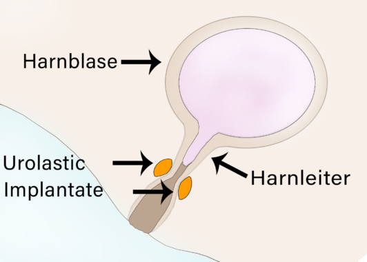 UROLASTIC : nachhaltiges Verfahren gegen Blasenschwäche